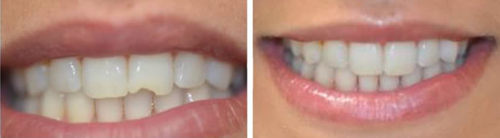 Before & After Dental Bonding | Ottawa Downtown Dentist